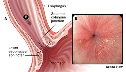 Gastroenterologists In Florida | Barrett's Esophagus ...