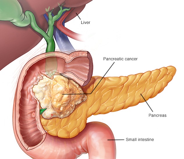 How Can You Detect Pancreatic Cancer / This study shows how to detect pancreatic cancer at ... - By picking up a few of the most important signs that present themselves when you develop pancreatic cancer you can catch it early before it becomes a major problem.