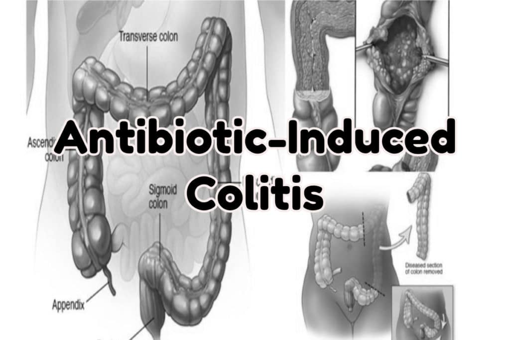 Antibiotic-Induced Colitis