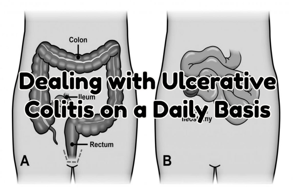 Dealing with Ulcerative Colitis on a Daily Basis