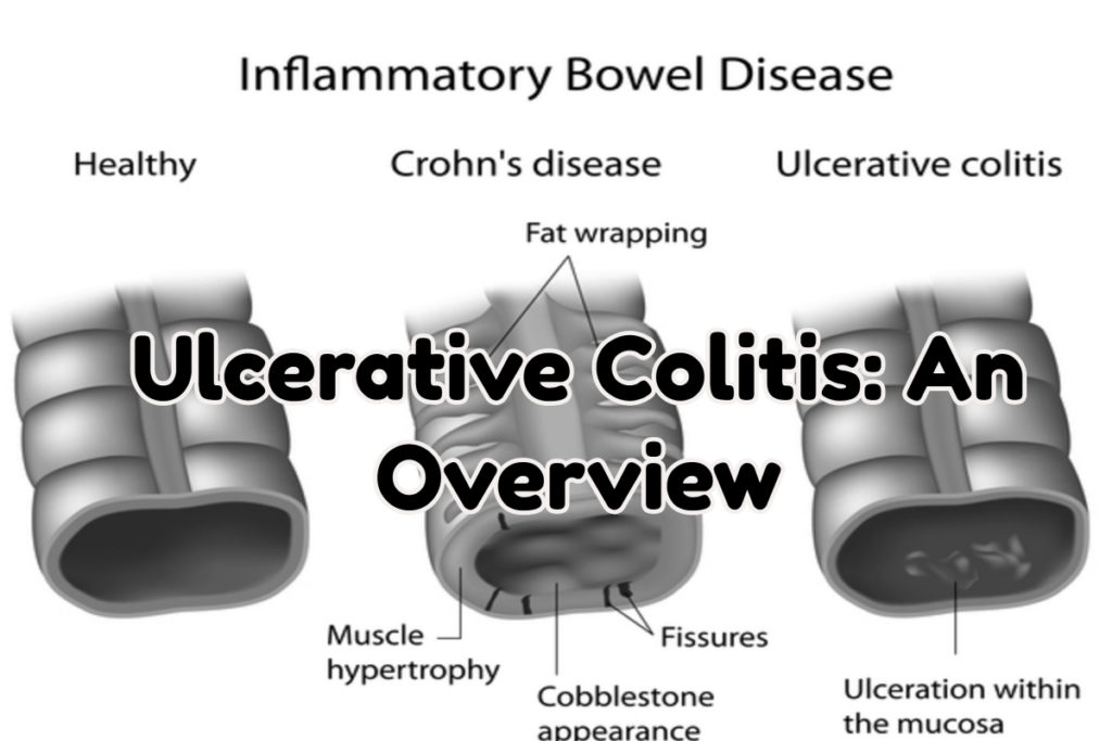 An Overview on Ulcerative Colitis