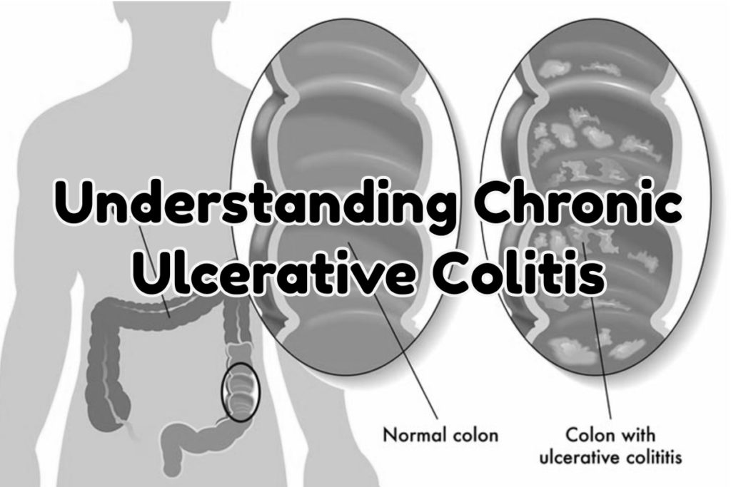Understanding Chronic Ulcerative Colitis