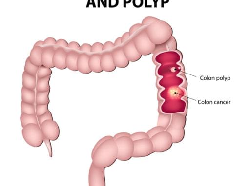 colon-cancer-and-colon-polyp-1