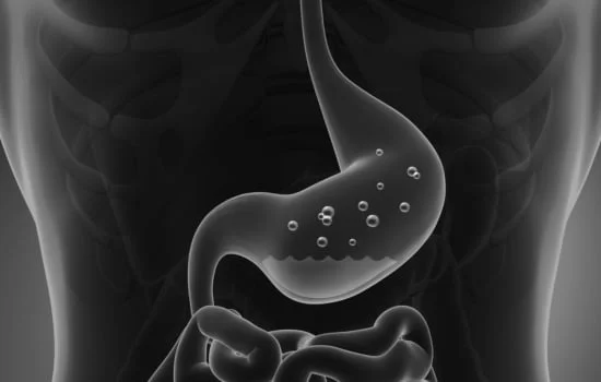 acid reflux disorder