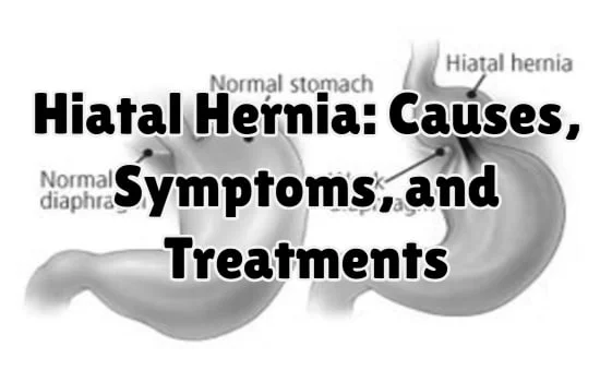 Hiatal Hernia- Causes, Symptoms, and Treatments