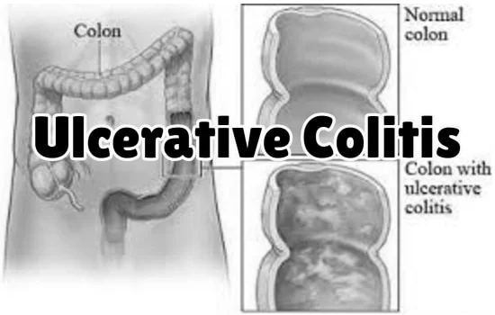 Ulcerative Colitis