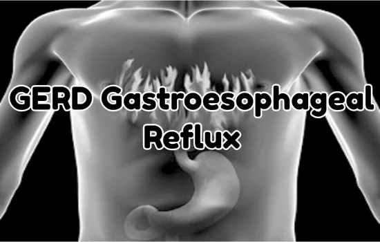 GERD Gastroesophageal Reflux