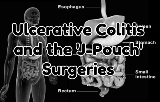 Ulcerative Colitis and the 'J-Pouch' Surgeries