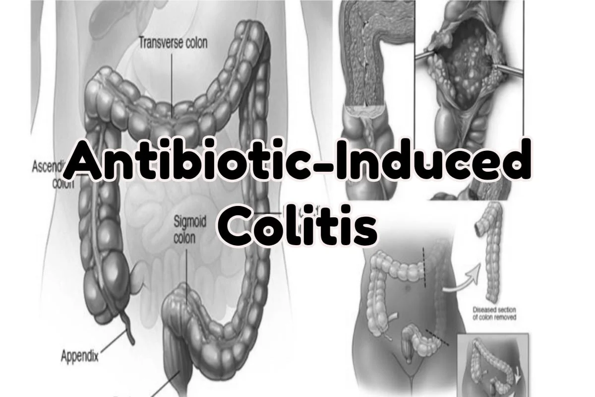 Antibiotic-Induced Colitis