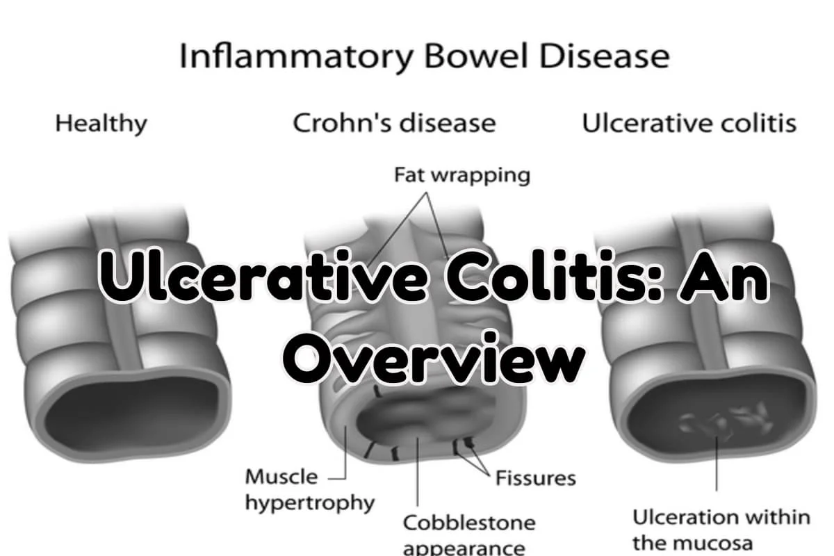 An Overview on Ulcerative Colitis
