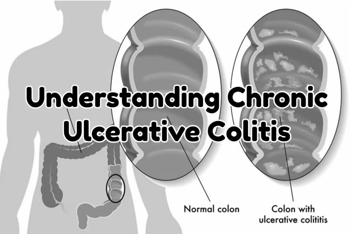 Understanding Chronic Ulcerative Colitis