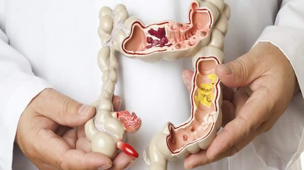 semaglutide rectal bleeding Rectal Bleeding Diagnosis, Management, and Treatment